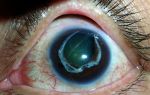 Возможно ли сохранить зрение после острого приступа глаукомы и чем экстренно снять симптомы