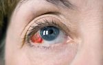 Опасны ли красные пятна в глазах: определение причины и лечение