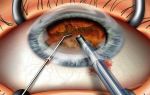 Какие осложнения после операции по удалению катаракты возможны и насколько они опасны?
