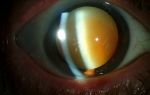 Чем грозит ядерная катаракта, что это такое и как ее лечить?