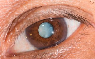 Лечение катаракты — самые эффективные капли и народные средства