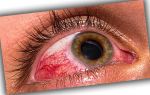 Акантамебный кератит, как защитить роговицу глаз и избежать заболевания?