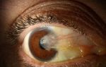 Бывает ли птеригиум глаза злокачественным: причины, симптомы и лечение образования
