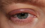 Как и чем снять аллергический отек глаз и опасен ли он для жизни?