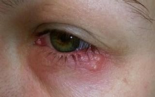 Офтальмогерпес или герпес на глазах: как проявляется и правильно лечится?