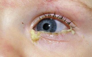 Что делать, если у ребенка гноятся глаза: причины, обзор всех способов лечения