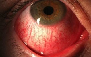 Что такое склерит (воспаление склеры глаза) и как его вылечить без последствий