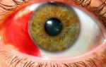 Что такое эписклерит глаз: симптомы, лечение, профилактика