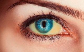 Почему белки глаз становятся желтыми: причины и лечение