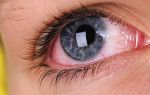 Причины сухости глаз от контактных линз — профилактика пересыхания роговицы