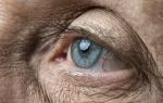 Что такое макулодистрофия сетчатки глаза: признаки и эффективное лечение