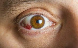 Почему возникает ретинопатия глаз и как ее вылечить
