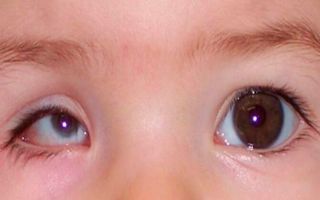 Что такое микрофтальм глаз — в чем опасность заболевания