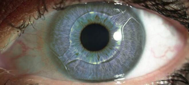 Как можно восстановить плохое зрение: доступные способы и методы лечения