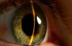 Что такое закрытоугольная глаукома и что о ней нужно знать, чтобы не потерять зрение