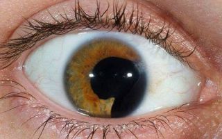 Что такое колобома глаза: есть ли опасность для зрения и нужно ли лечить