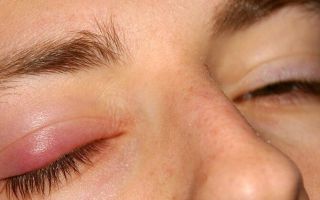 Причины воспаления века глаза — эффективные методы лечения и профилактика