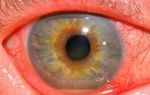 Иридоциклит глаз (передний увеит) простыми словами: лечение, симптомы, профилактика