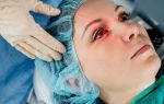 Операция ФРК глаза — современный метод коррекции зрительных нарушений