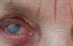 Бельмо на глазу человека: симптомы, причины, эффективное лечение