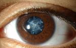 6 работающих методик гимнастики для глаз при катаракте