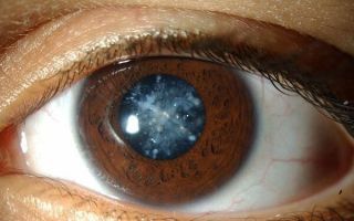 6 работающих методик гимнастики для глаз при катаракте