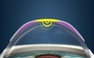 Ортокератологические линзы — Восстановление зрения без операции