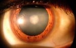 Причины и лечение вторичной катаракты после замены хрусталика