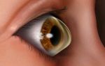 Что такое кератоконус глаз: причины, симптомы и возможные методы лечения
