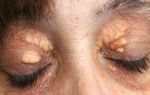 Опухоль на веке глаза: доброкачественные и злокачественные новообразования