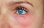 Почему под глазами и вокруг появляются красные пятна: диагностика и действенное лечение