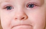 Особенности вирусного конъюнктивита глаз у ребенка: лечение, симптомы, профилактика