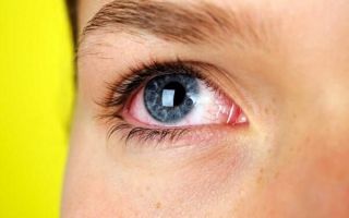 Почему покраснел и слезится глаз: возможные причины и эффективное лечение