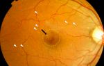 Отек сетчатки глаза после операции: как выявляется и лечится патология