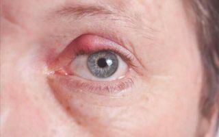 Ячмень на глазу (гордеолум): лечение и ответы на популярные вопросы