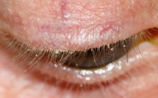 Демодекоз глаз (клещ демодекс на веках): симптомы и лечение