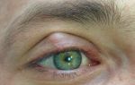 Что такое халязион на глазу и насколько он опасен: лечение, причины, симптомы