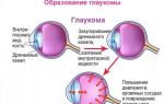 Глаукома: причины, симптомы и лечение в Екатеринбурге