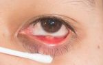 Особенности внутреннего ячменя на глазу (мейбомита), симптомы и лечение